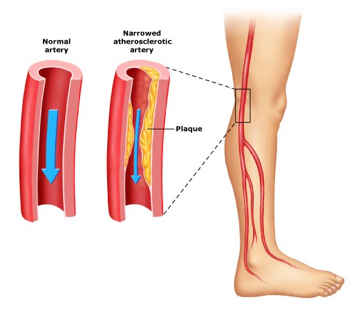 How To Calculate Systemic Vascular Resistance